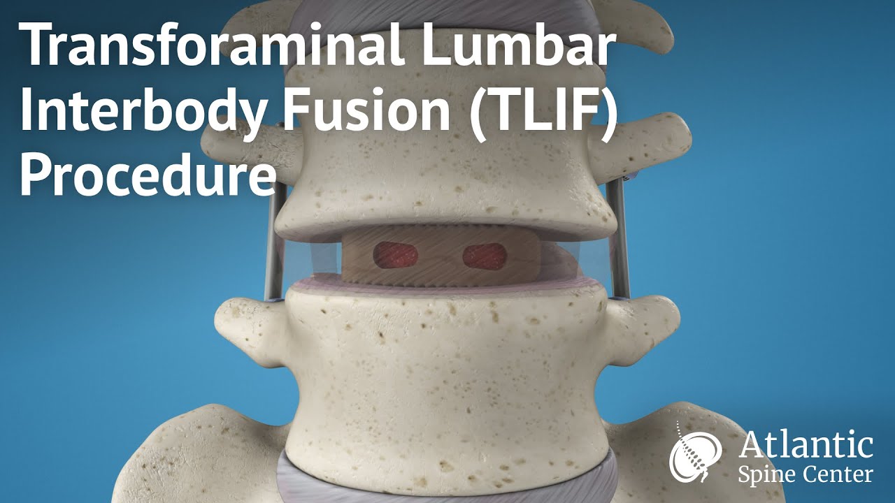 Transforaminal Lumbar Interbody Fusion(TLIF) Procedure