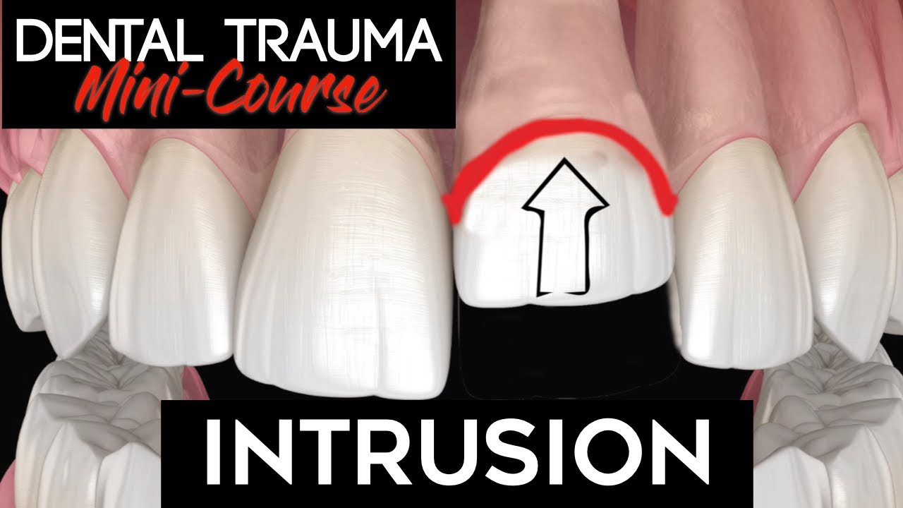 Dental Trauma Mini-Course - Part 8 - Dental Trauma Guide - Intrusion Injury