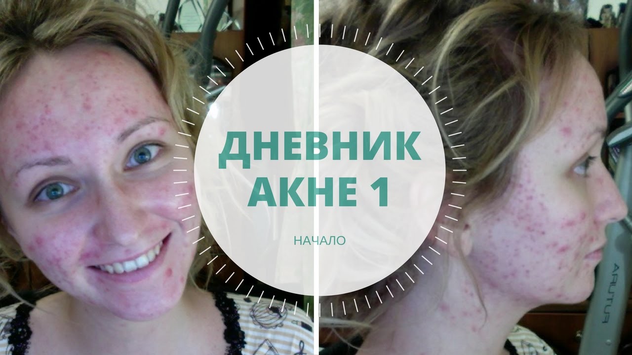 ДНЕВНИК АКНЕ 1. НАЧАЛО