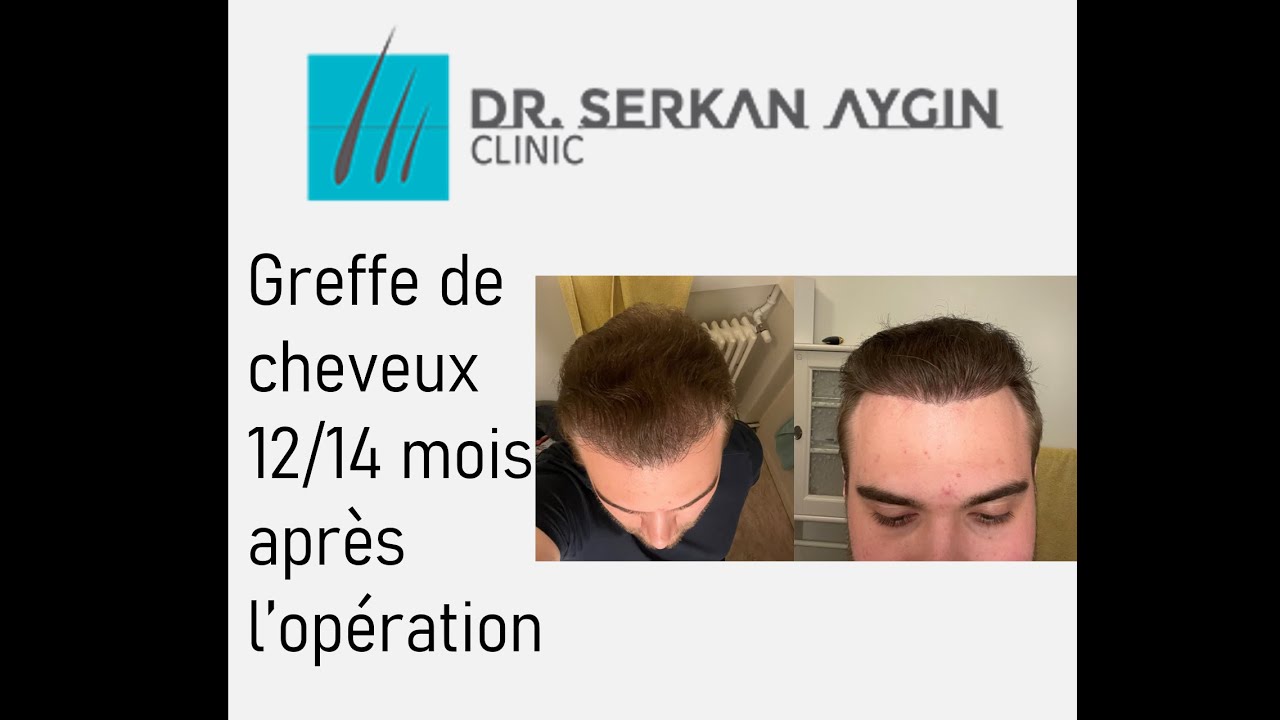 Greffe de Cheveux | 12/14 Mois après l'opération | Clinique du Dr Serkan Aygin