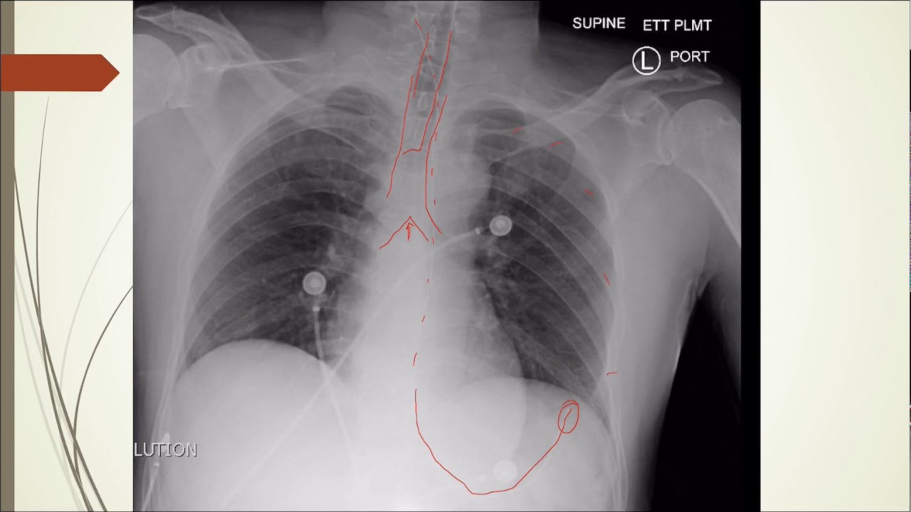 CXR ETT placement verification