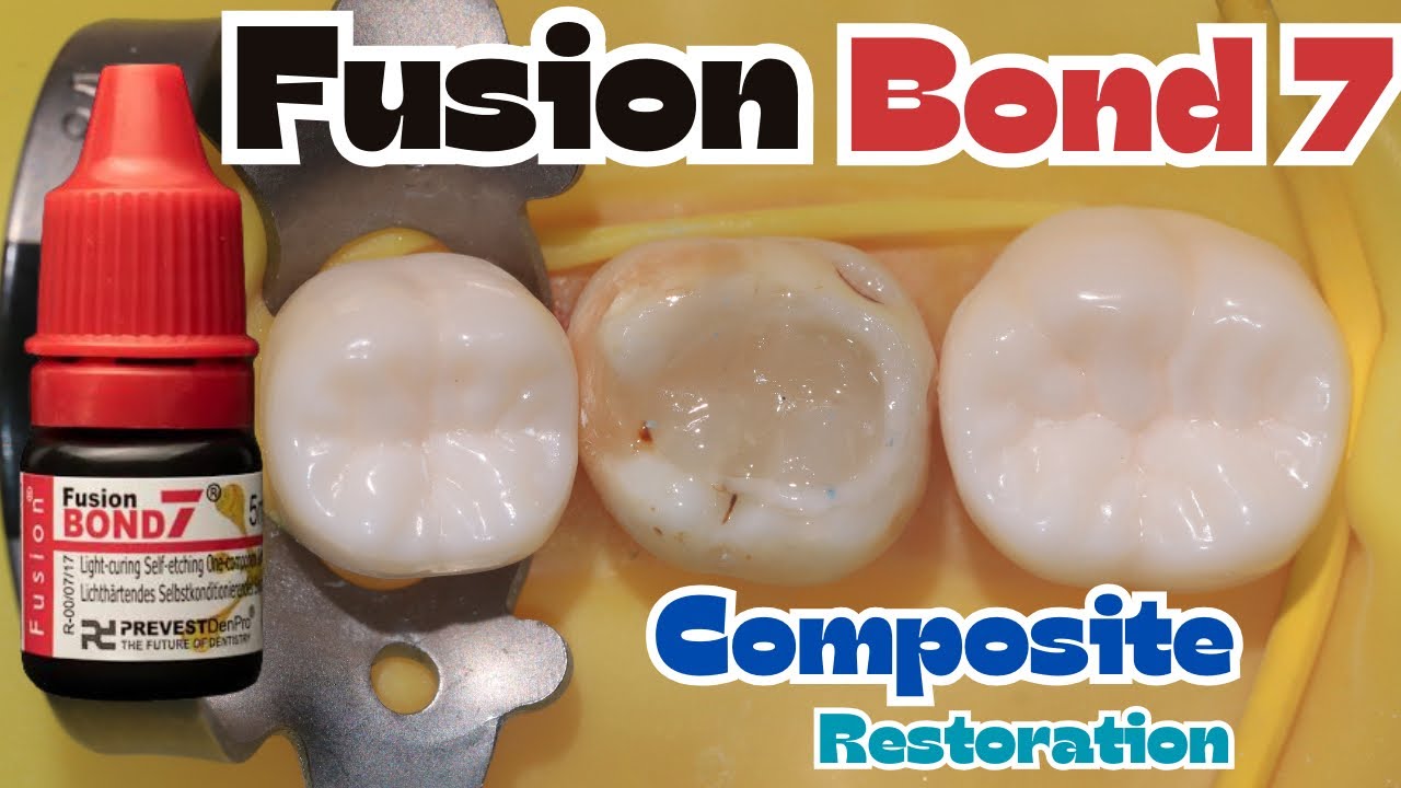 Fusion Bond 7 🔴  Class I Composite Restoration on Mandibular Second Molar ⚪️ Prevest Denpro