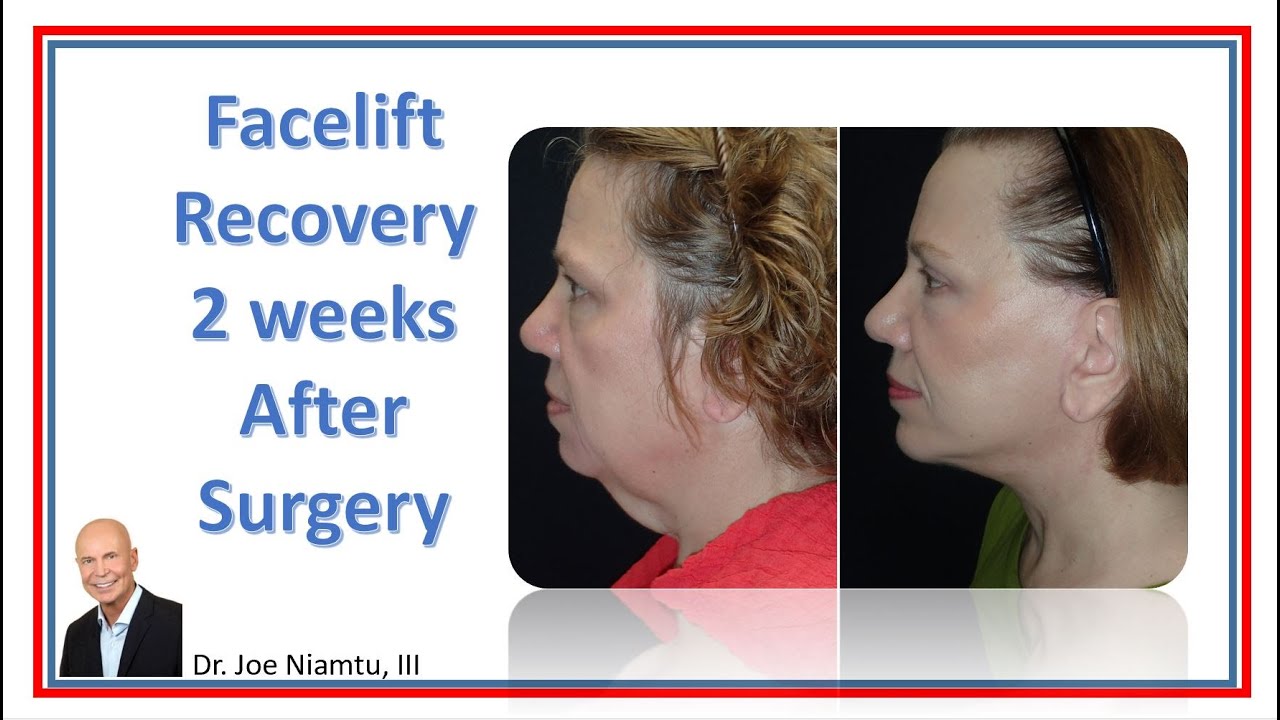 Facelift Recovery After 2 Weeks