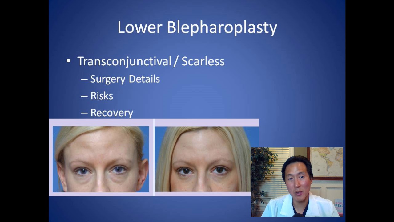 How Can I Make The Bags Under My Eyes Go Away - Lower Blepharoplasty Consultation - Dr. Anthony Youn