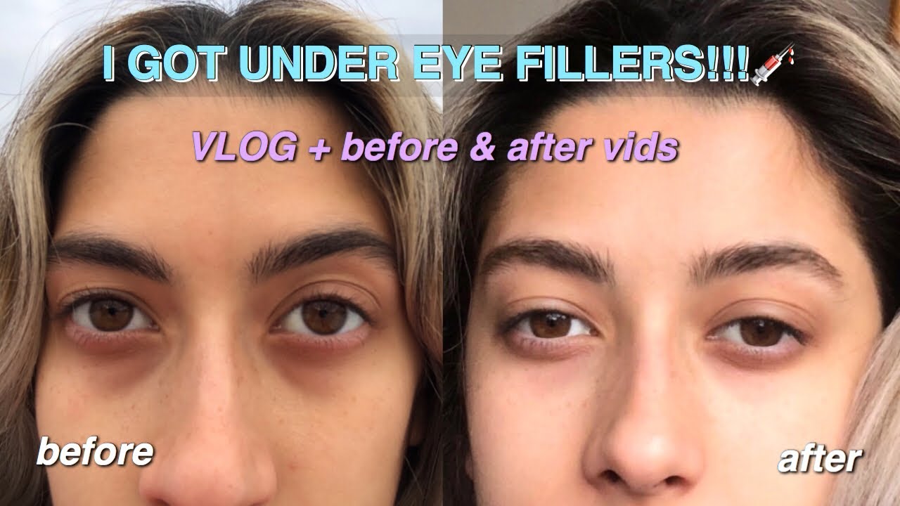 I GOT UNDER EYE FILLER FOR MY DARK CIRCLES (vlog + before and after clips)