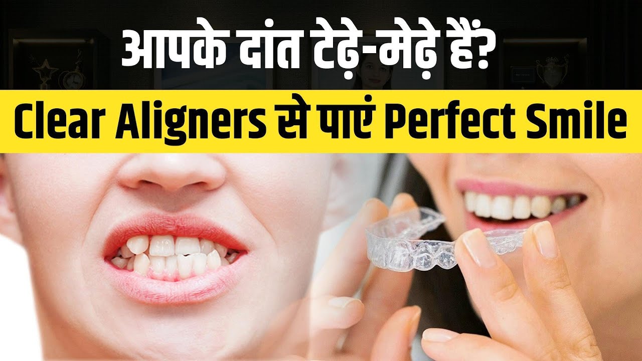 आपके दांत टेढ़े-मेढ़े हैं? Clear Aligners से पाएं Perfect Smile | Best Dentist In Jaipur