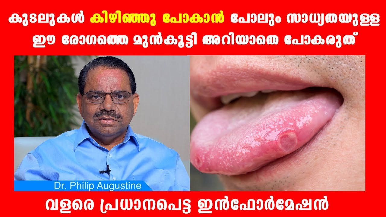 കുടലുകള്‍ കിഴിഞ്ഞു പോകാന്‍ പോലും സാധ്യതയുള്ള ഈ രോഗത്തെ തിരിച്ചറിയാതെ പോകരുത്  (IBD)Baiju's Vlogs