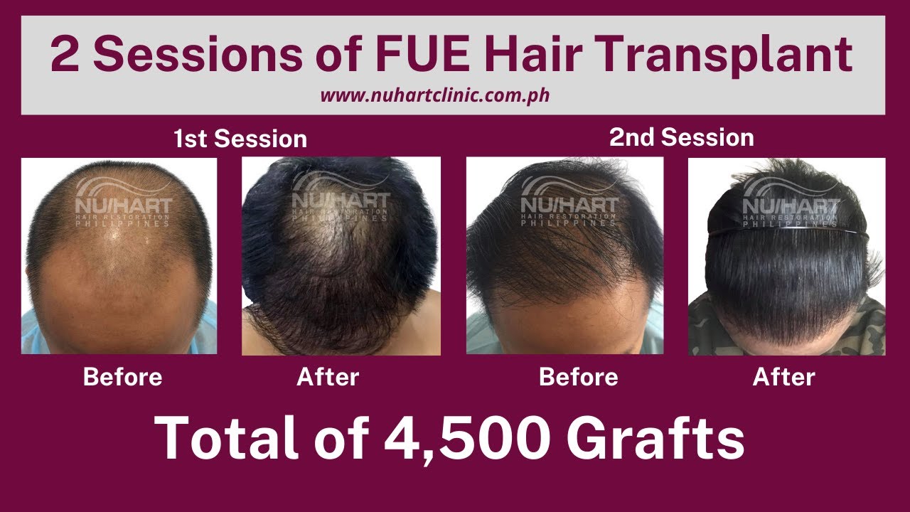 2 Sessions of FUE Hair Transplant | Total of 4,500 Grafts