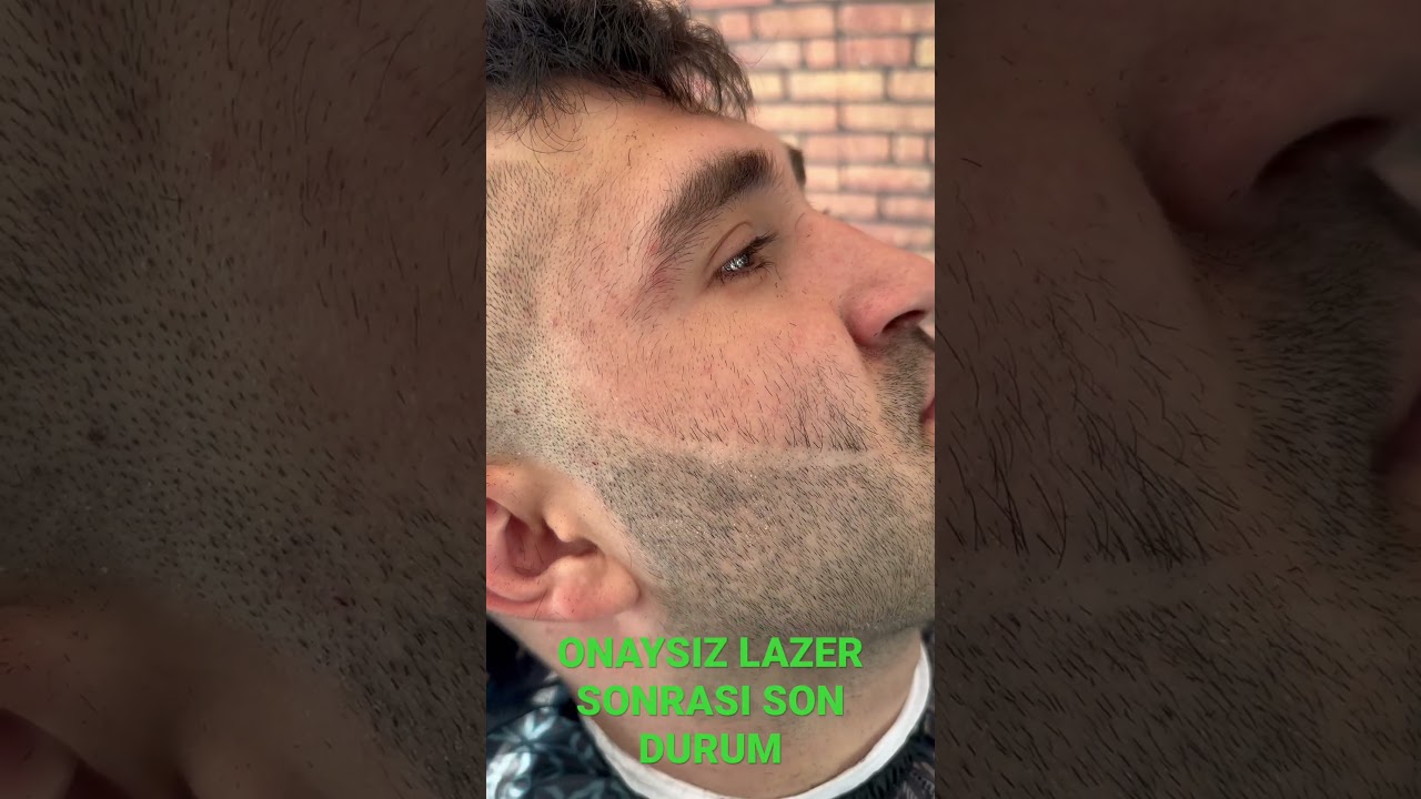 ONAYSIZ LAZER SONRASI 