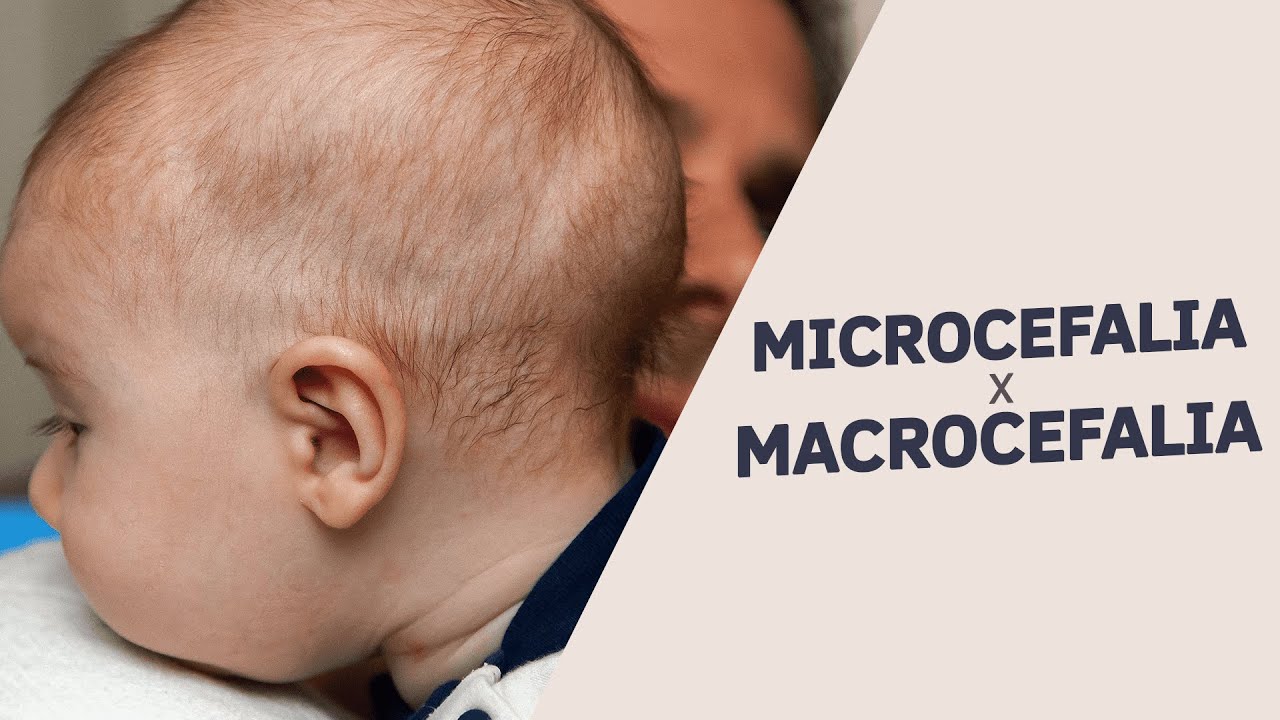 Microcefalia e Macrocefalia: Qual é a Diferença e Como identificar a Deformidade do Crânio do Bebê?