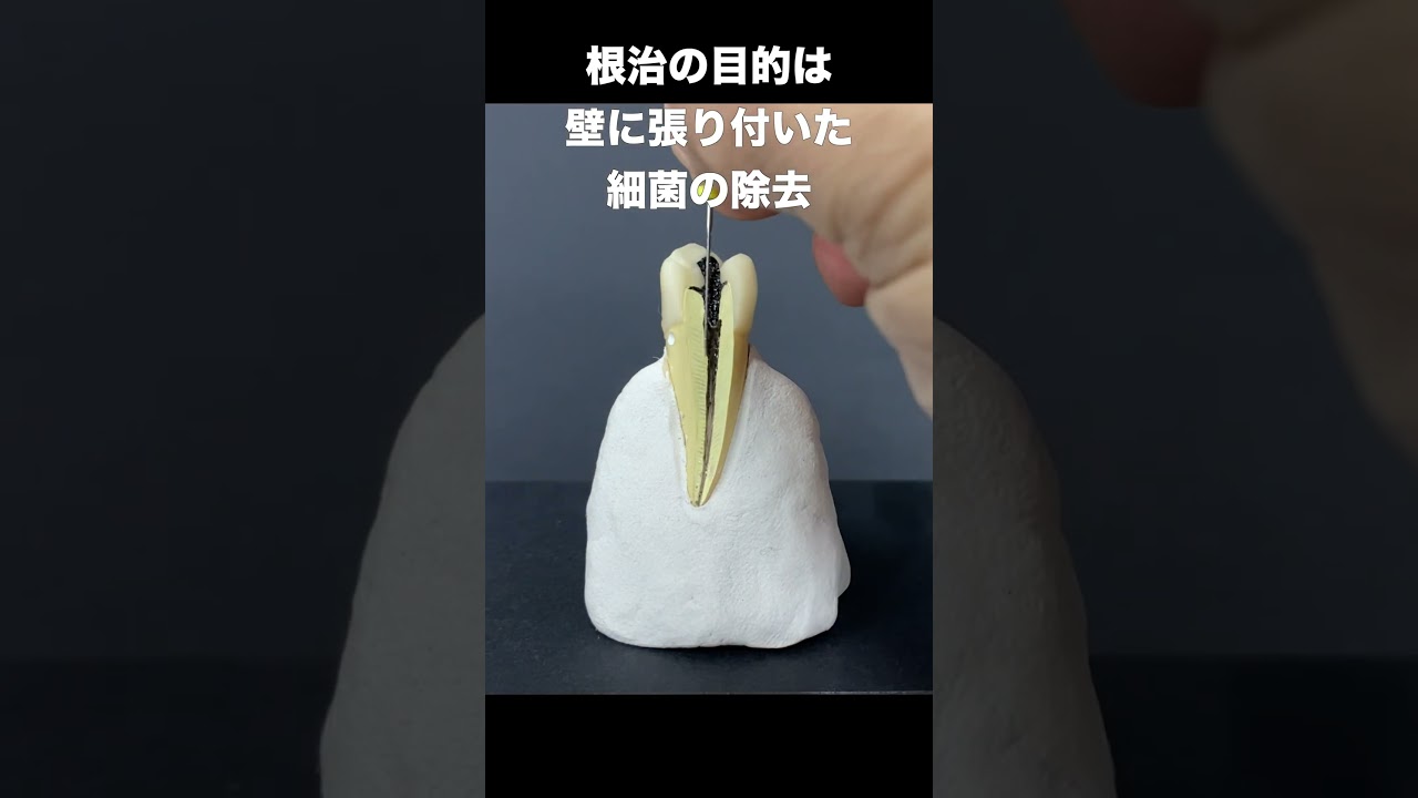 【戸塚駅前内藤歯科】根管治療を簡単にご説明 #shorts #根管治療