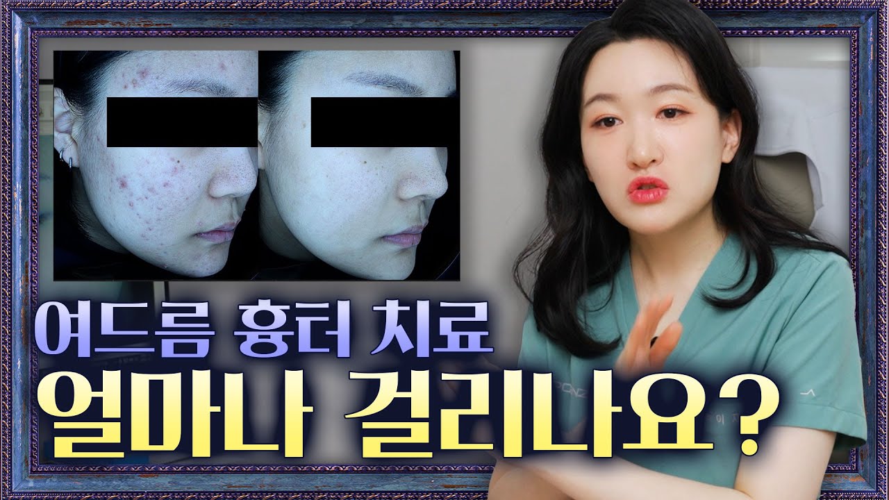 피부과 여드름 흉터 치료! 이 정도면 달라집니다!