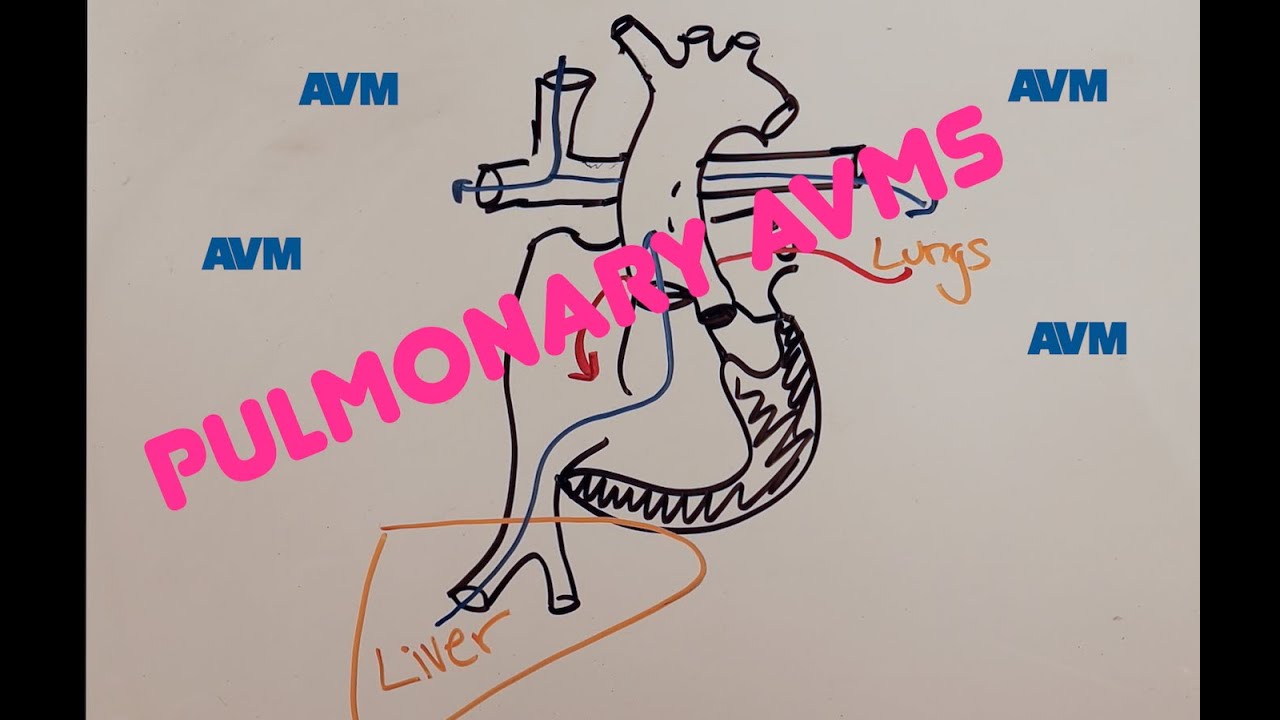 Pulmonary arteriovenous malformations in CHD