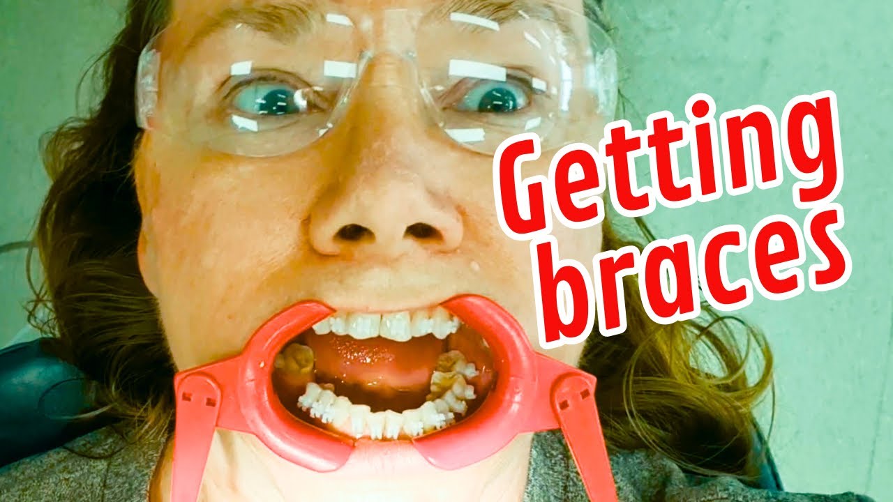 Getting adult braces put on - FULL PROCESS
