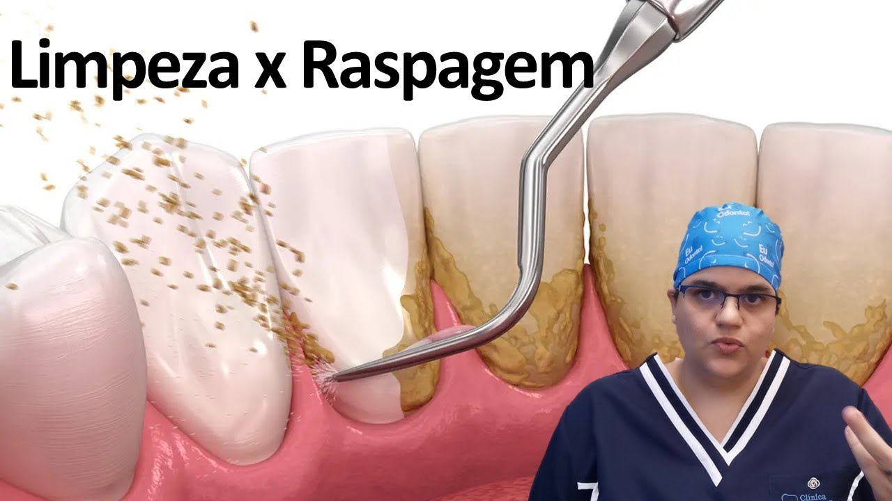 Qual a diferença entre limpeza e raspagem? | Dra Bianca Rosa | Clínica Bianca Rosa