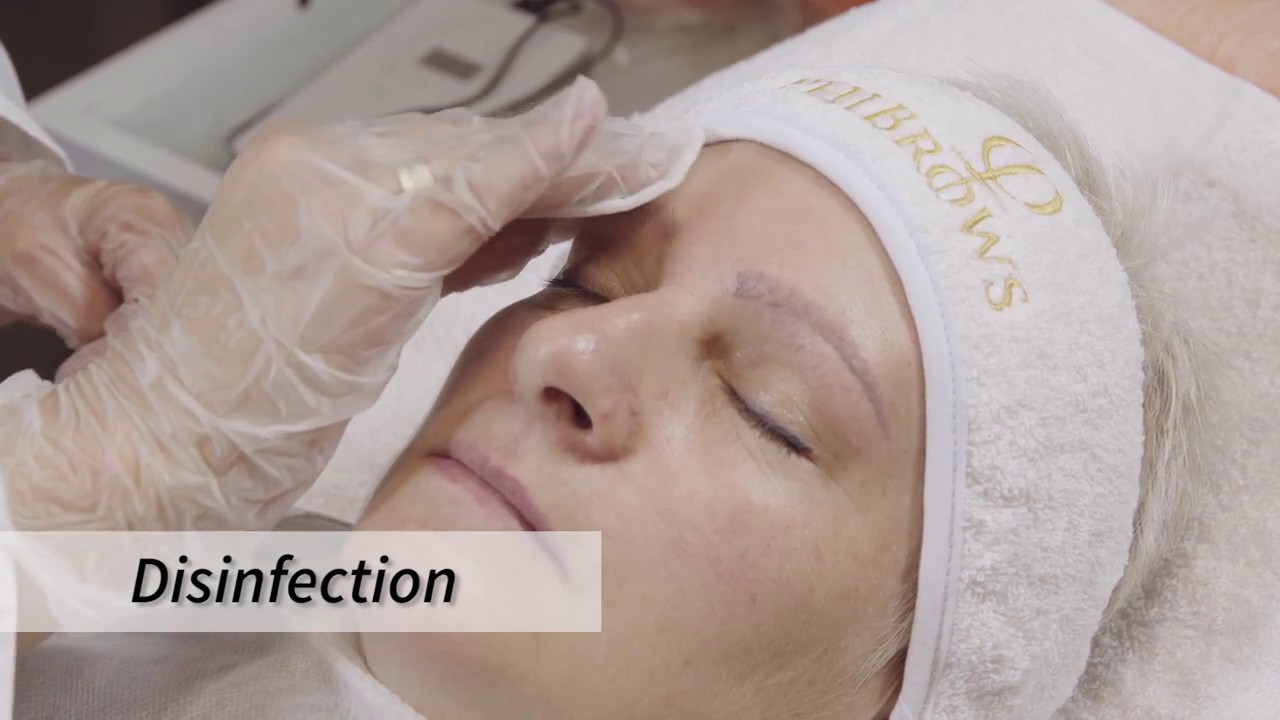 Phiremoval method via Ella Sakalauskienė