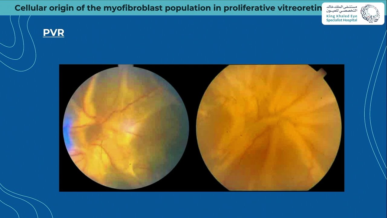 Cellular Origin of the Myofibroblast  Population in Proliferative Vitreoretinal Disorders