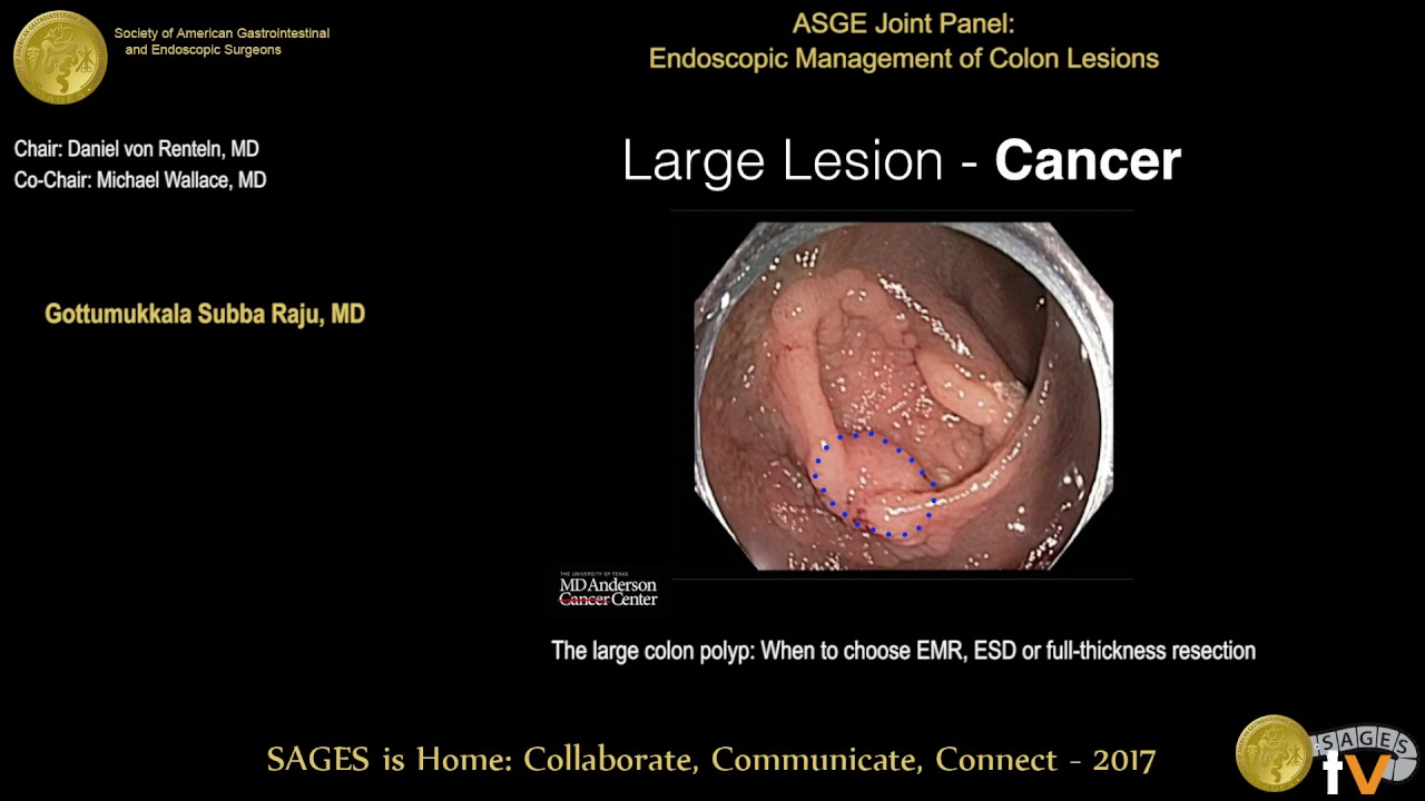 The large colon polyp: When to choose EMR, ESD or full-thickness resection