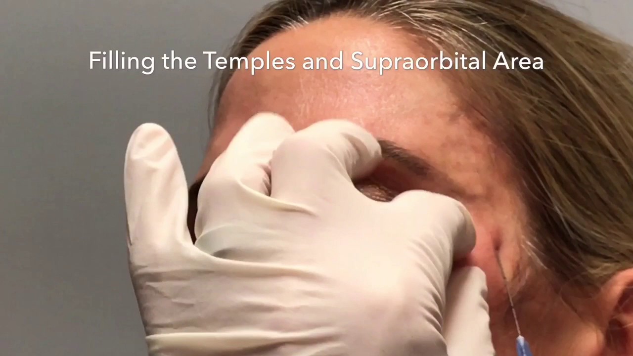 Filling the Temples with Restylane Refyne - Steven F Weiner, MD