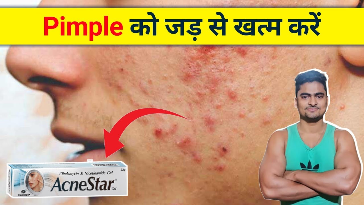 Pimple Removal Gel - AcneStar l How to Remove Acne & Pimple ? Pimple Hatane Ka Tarika l AcneStar l