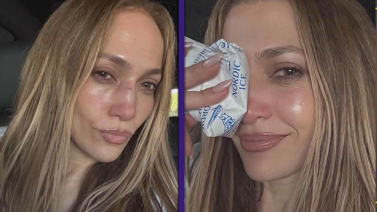 Jennifer Lopez Needs Stitches After American Music Awards Rehearsals