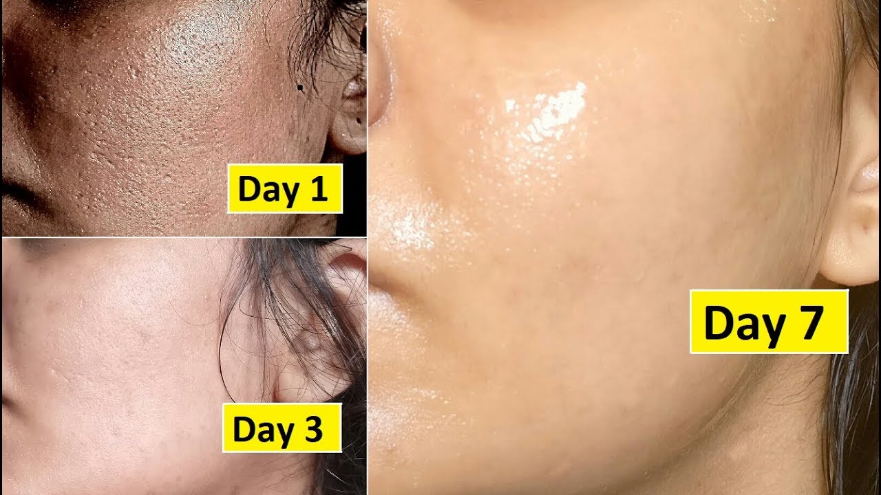 Skin Repair | Close Large OPEN PORES in 1 week, Remove Dark Spots, Anti Aging
