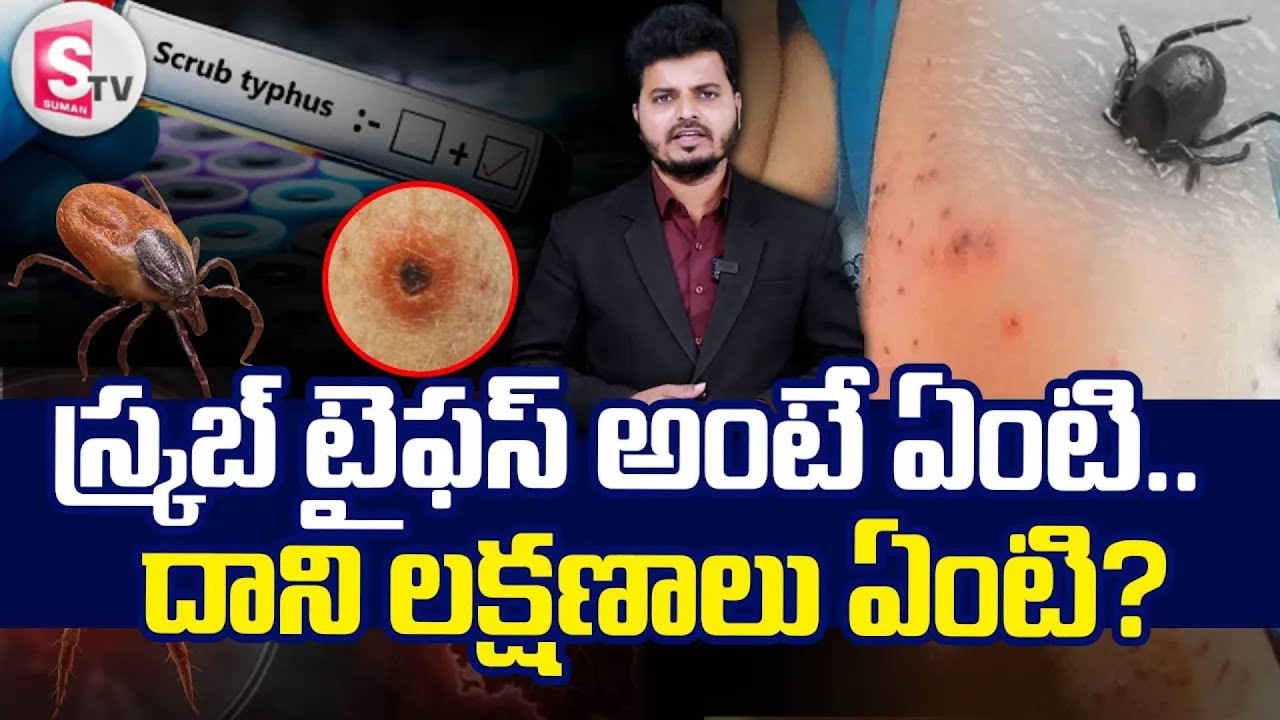 స్క్రబ్ టైఫస్ అంటే ఏంటి.. | AP Scrub Typhus Updates | Scrub Typhus Disease Symptoms | SumanTV Sai
