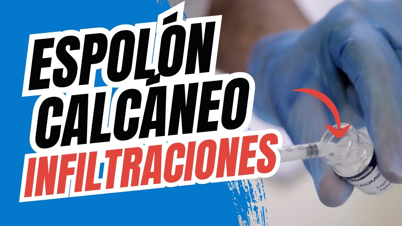 🚨 INFILTRACIONES para el ESPOLÓN CALCÁNEO: ¿Solución o PELIGRO?