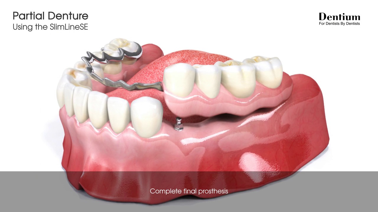 Partial denture | SlimLineSE