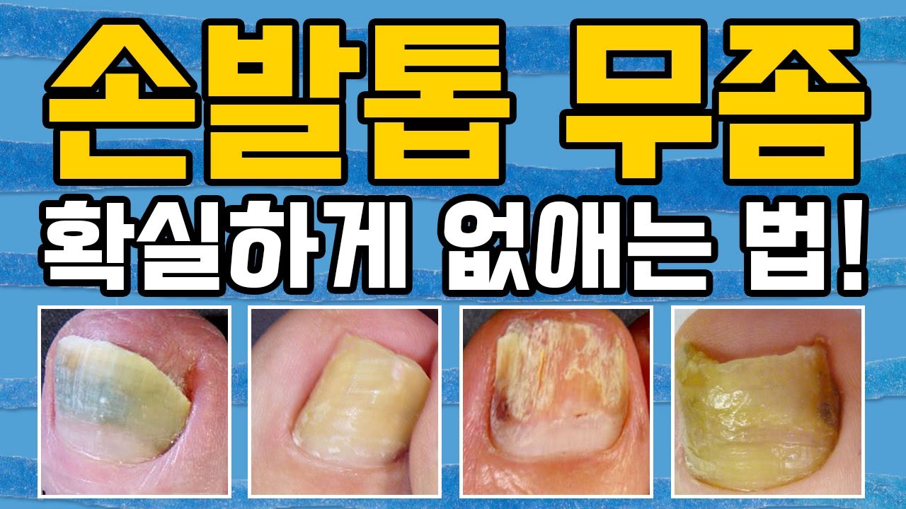 손발톱 무좀? 낫고 싶다면 드루와