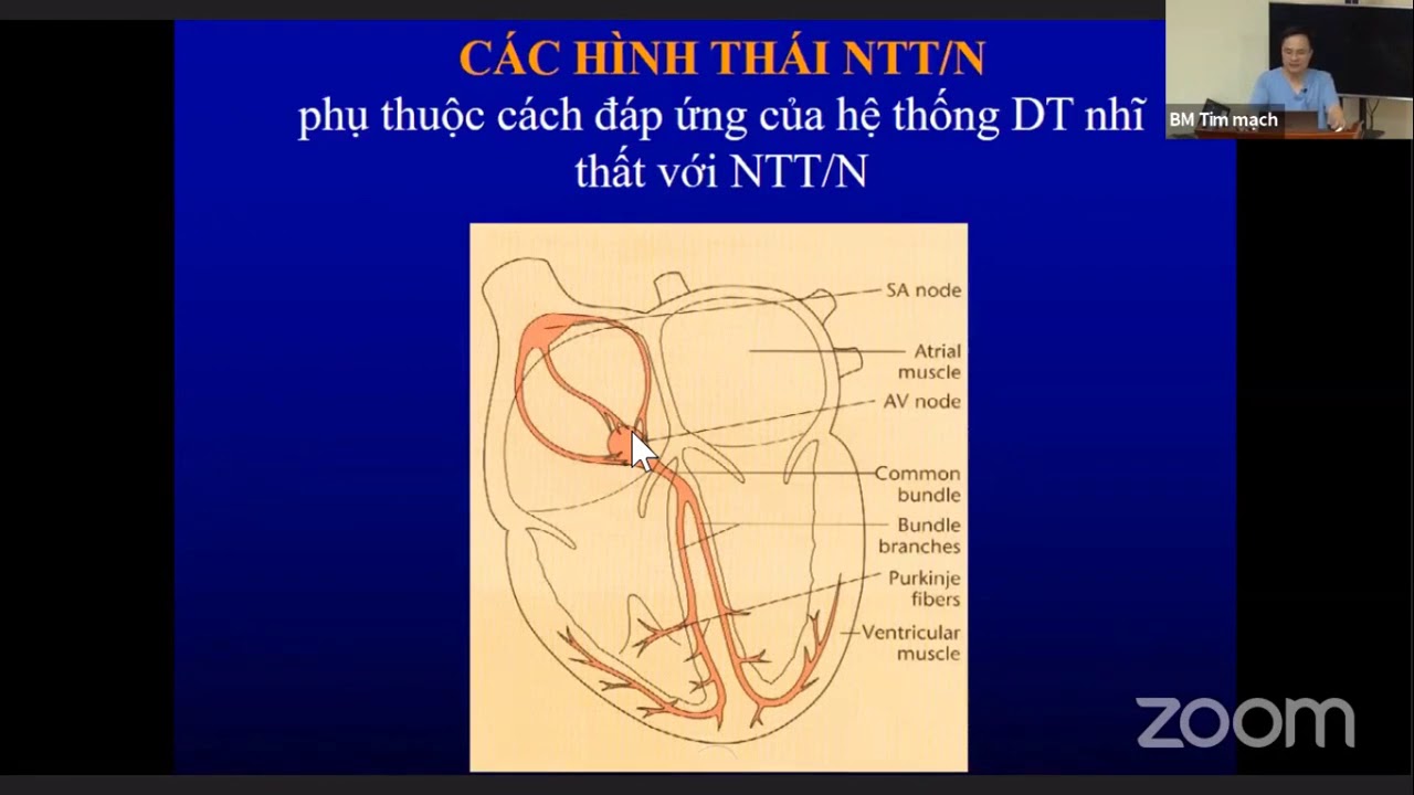 Ngoại tâm thu: Tiếp cận và xử trí [Tim mạch 16/25]