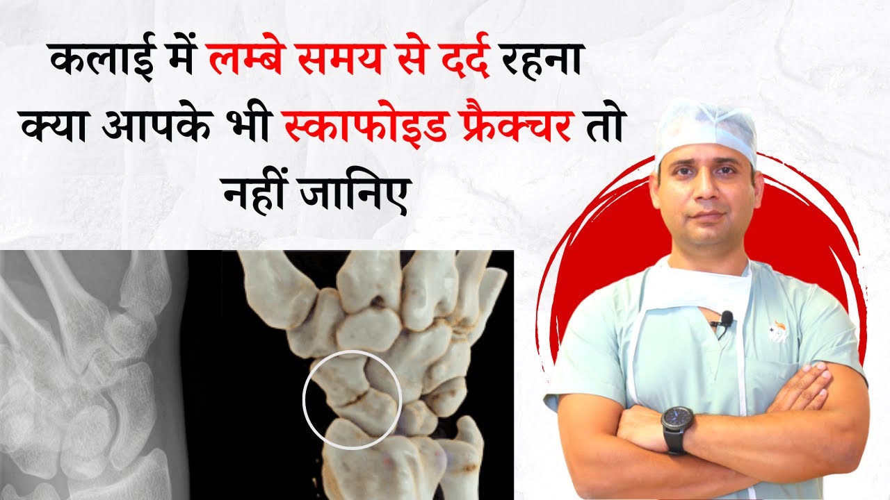 Scaphoid Bone me fracture ka treatment kaise hoga/ nonunion in scaphoid bone /best scaphoid bone