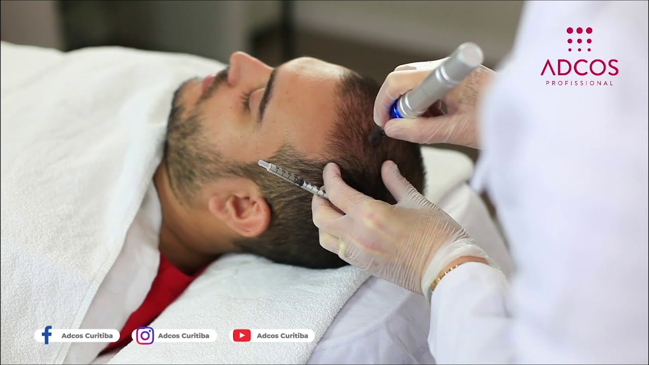 Protocolo com Microagulhamento no Tratamento da Alopecia Capilar