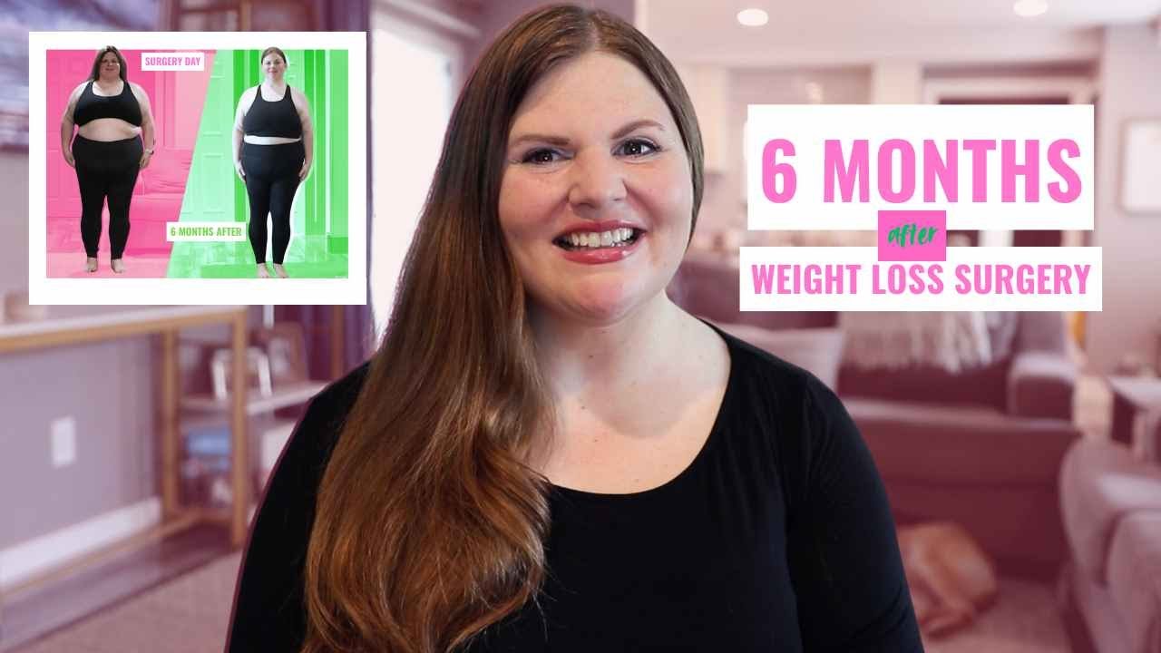 6 months after Weight Loss Surgery | How much weight lost after WLS? | Results and Side by Sides