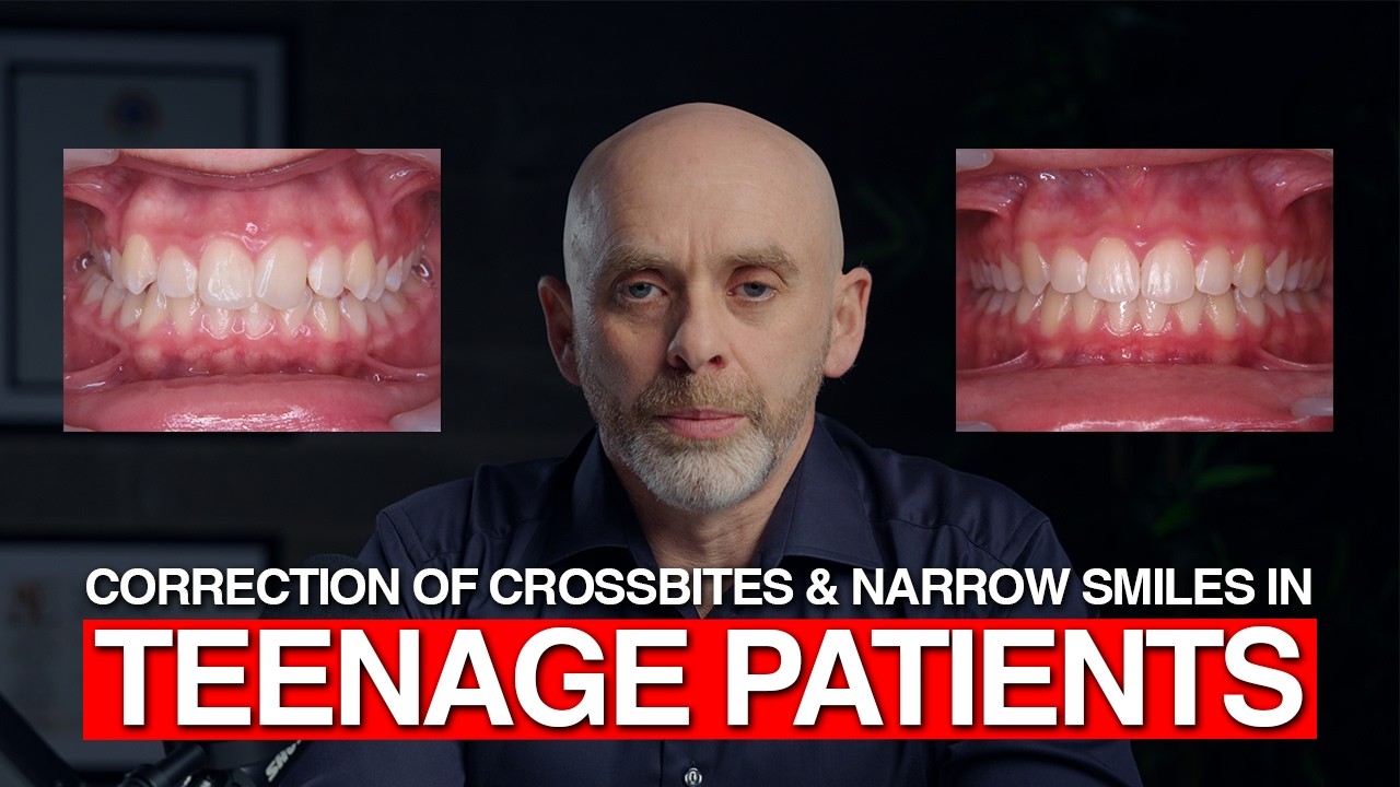 Correction of Cross bites & Narrow smiles in teenage patients | Orthodontics by Dr. Kieran Daly