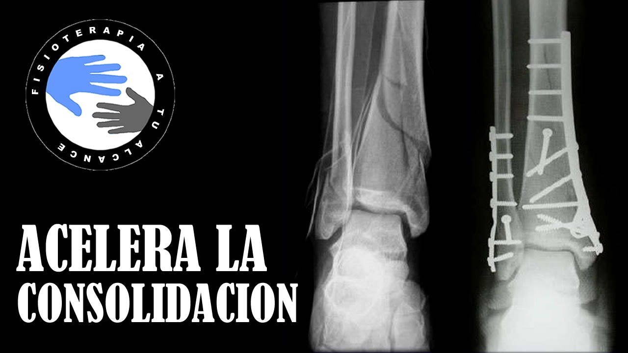 Como acelerar la curacion de una fractura de hueso