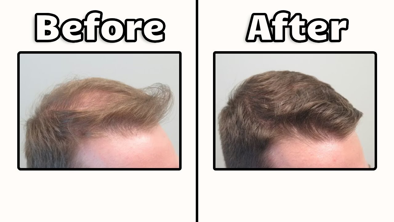 How To Reverse Hair Loss In 2026 (Full Guide)