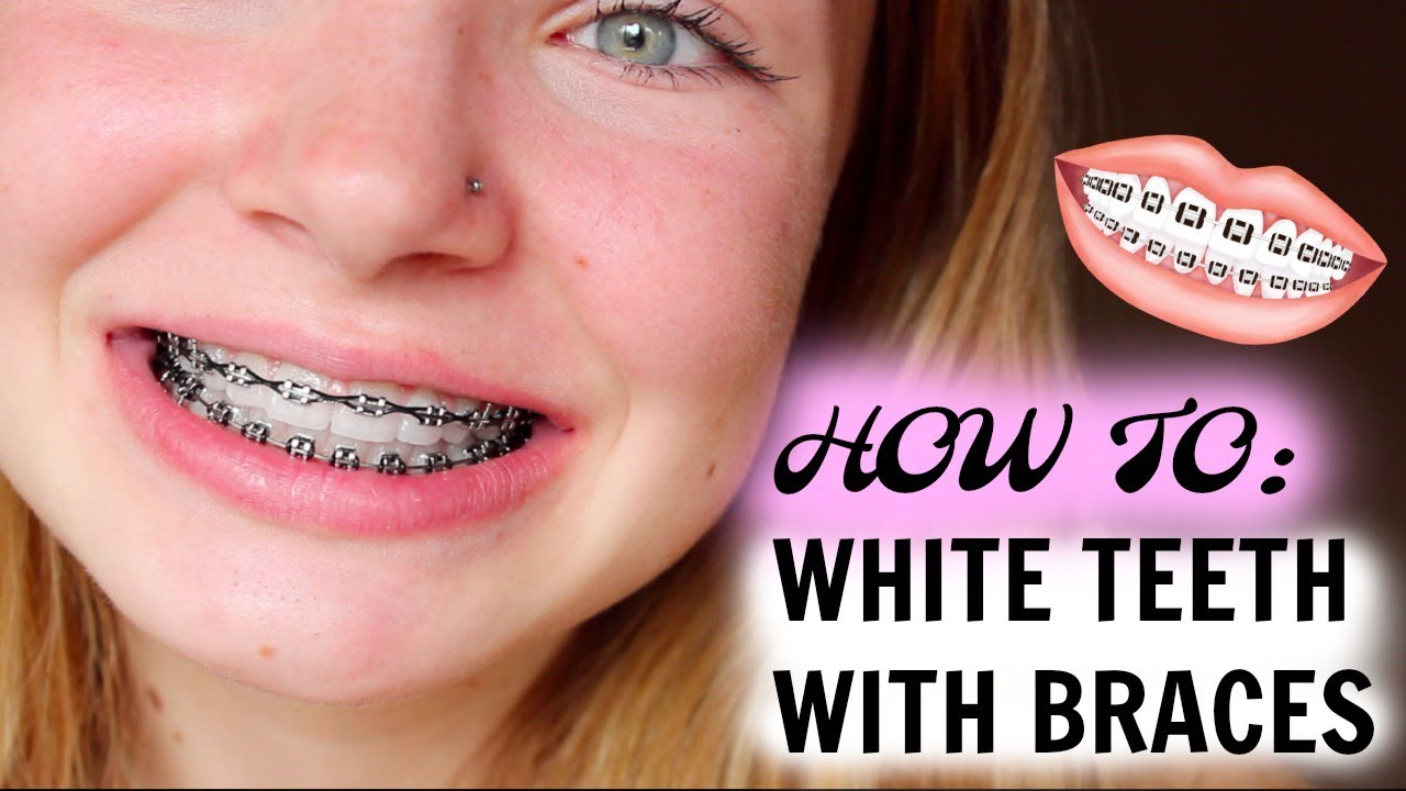 HOW I MAINTAIN WHITE TEETH WITH BRACES