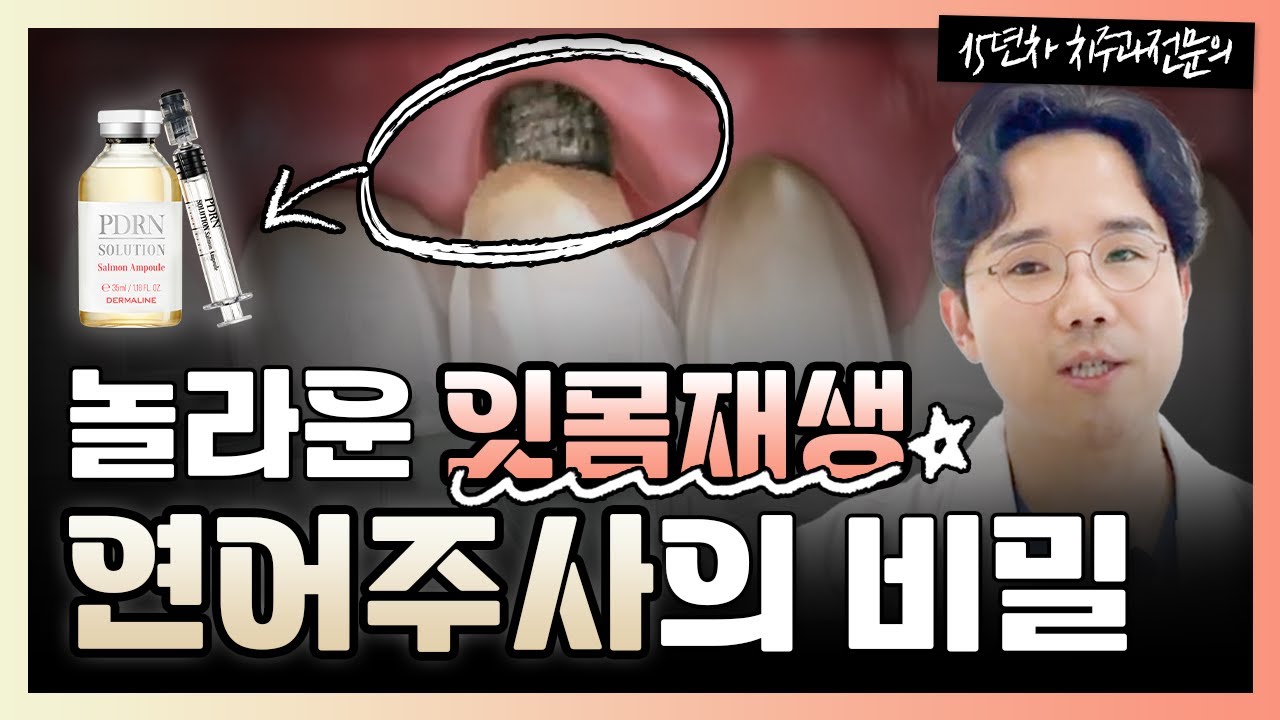 잇몸내려앉음 다시 올라갈까? PDRN 연어주사 잇몸재생주사 모든것
