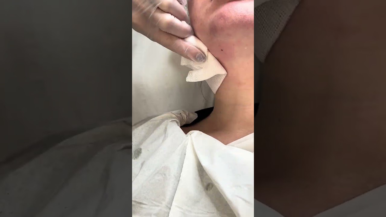 Lemon Bottle Chin