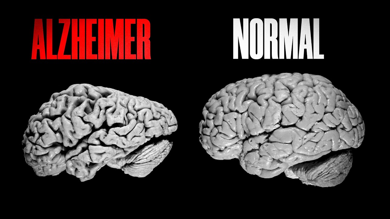 O que CAUSA o ALZHEIMER?
