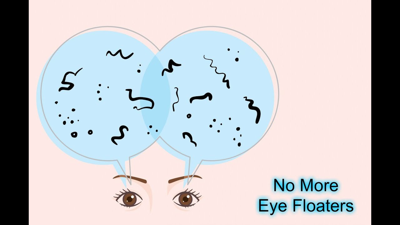 Eye Floaters and Flashes - No More