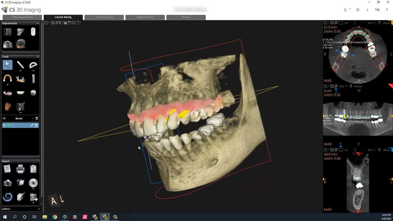 Carestream CS 3D Imaging to BlueSkyPlan Integration