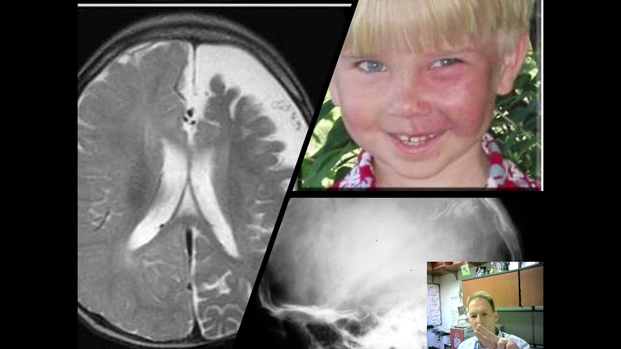 Seizure disorders in children – good and bad outcomes - Dr. K. Ess