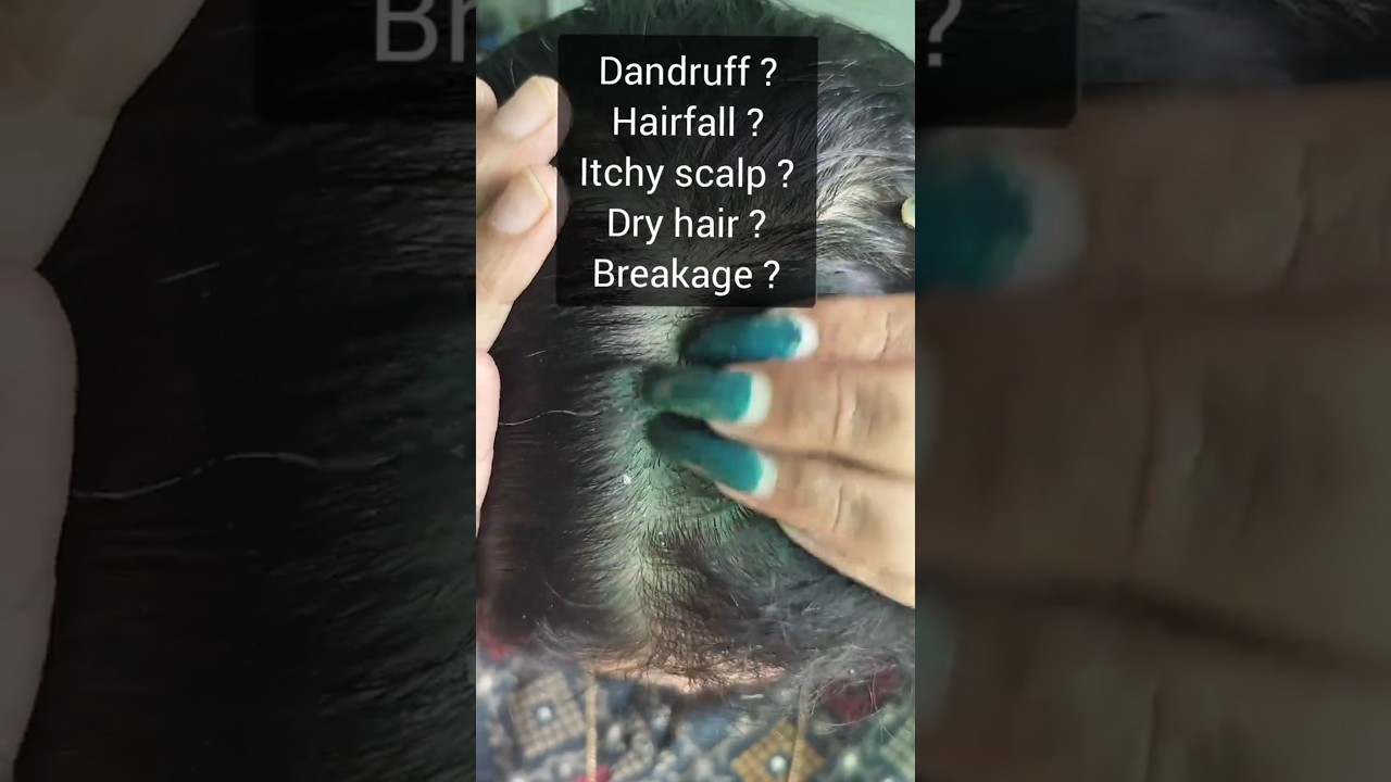 2 Simple Ingredients to Stop Dandruff ❌✨||DIY REMEDY