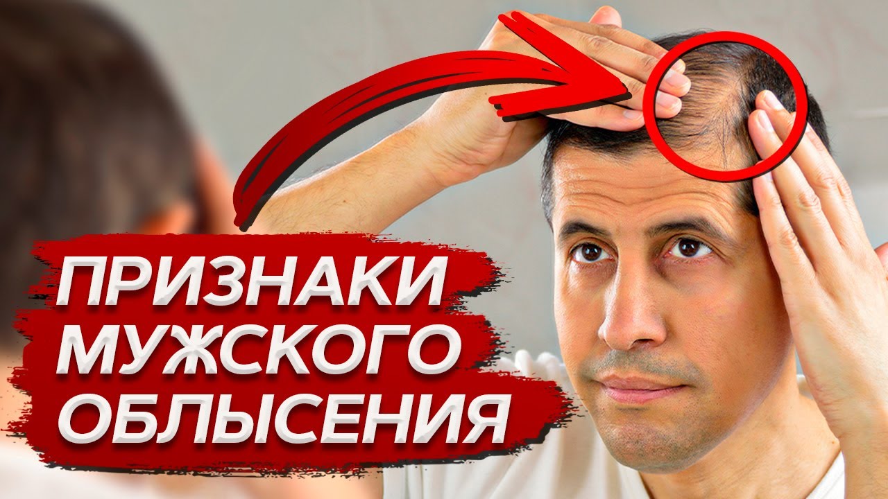 Почему у МУЖЧИН выпадают ВОЛОСЫ? / Учимся самостоятельно определять первые признаки облысения