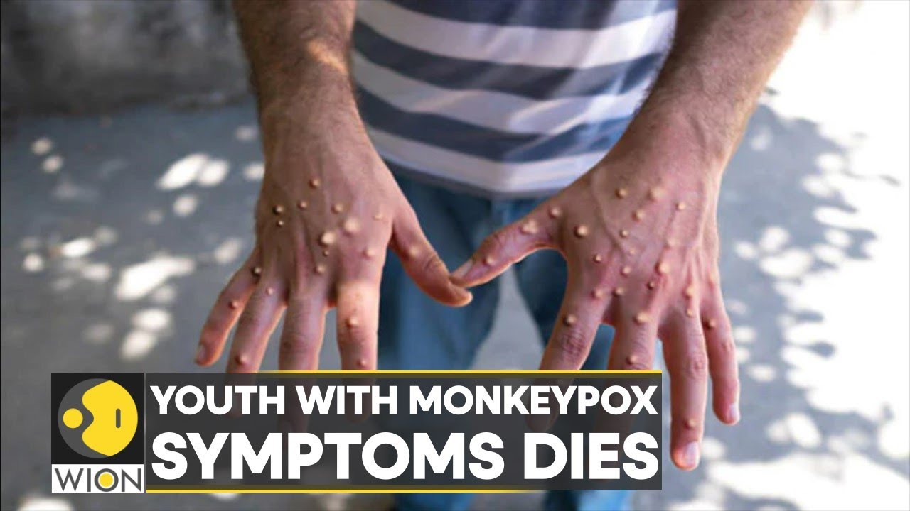 WION Dispatch | India: Kerala youth with Monkeypox-like symptoms dies | Latest English News