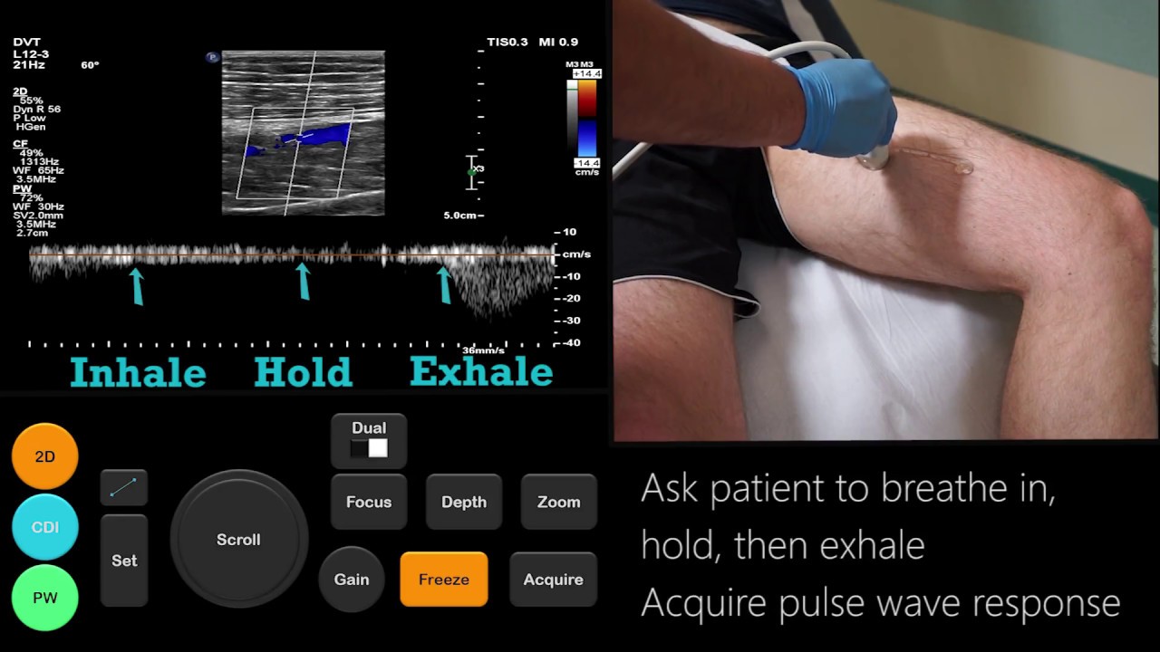 Учебное пособие по УЗИ: тромбоз глубоких вен нижних конечностей | Radiology Nation