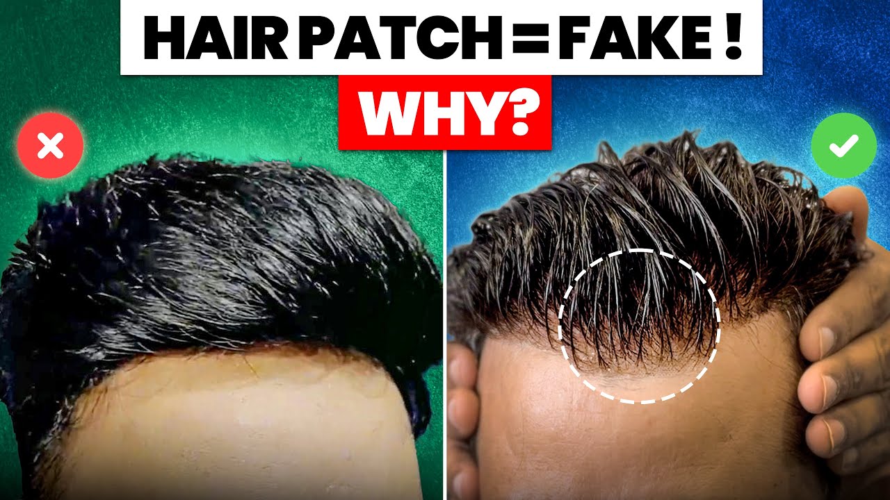 The Shocking Truth About Hair Patches Nobody Warns You About
