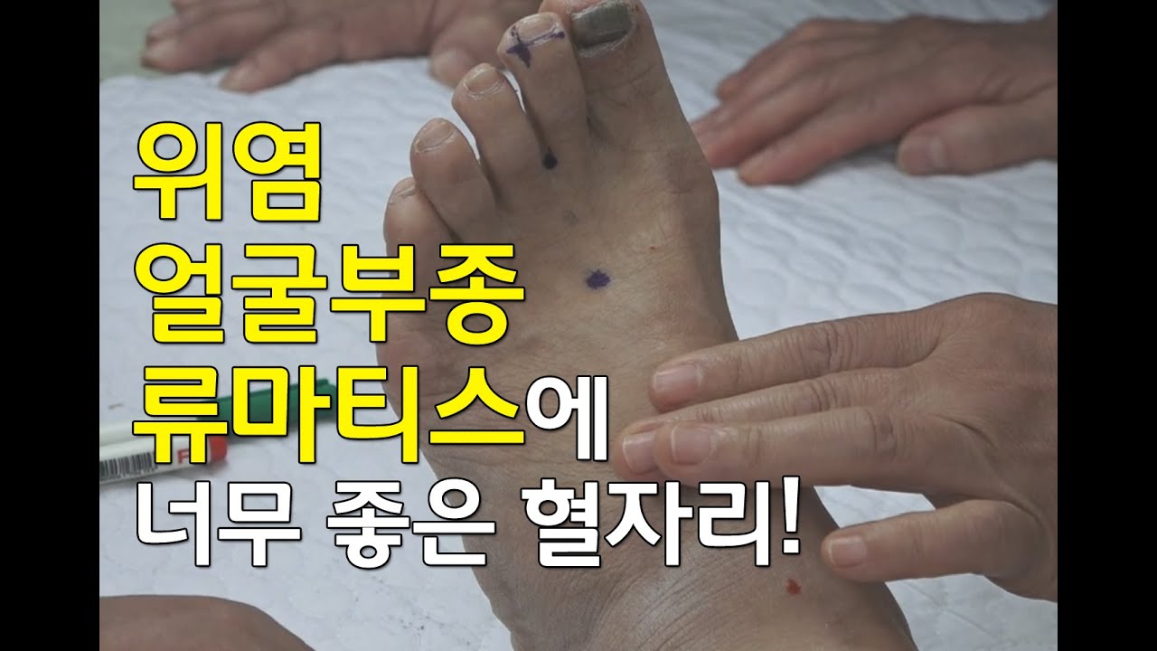 [김효열 교수의 재미있는 혈자리 공부] 위염, 얼굴부종, 류마티스 관절염 등에 좋은 혈자리(족양명위경)